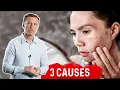Darkened Skin Spots 3 Causes of Dark Spots on Skin - Dr Berg