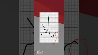 Mastering ECG Interpretation Wolff Parkinson White Syndrome Type A Explained For Medical Students 