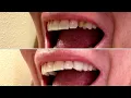 TempTooth Temporary Tooth Replacement Realistic Easy-to-Use Demo Review