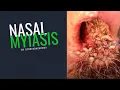 Download Lagu NASAL MYIASIS - NOSE LARVAE - MIIASE NASAL #SHORTS