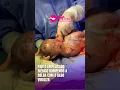 Download Lagu Médico rompe a bolsa amniótica do bebê com o dedo - Parto Empelicado