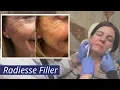 Lagu Radiesse Filler [Calcium Hydroxylapatite (CaHA) Injections]