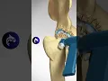 Total Hip Replacement Arthroplasty - 3D Animation