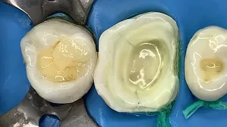 🔥Proceso Completo , Restauraciones Dentales Directas e Indirectas🔥