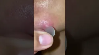 منتج ازاله حبوب الوجه خلال24ساعه 