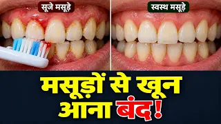 मसूड़ों से खून आना और पायरिया का पक्का इलाज | Masudo ki Kamzori ka Gharelu Upay
