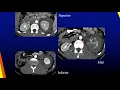 Imaging renal and bladder trauma