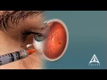 Download Lagu How Macular Degeneration Affects Your Vision - 3D animation