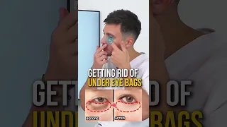 Removing UNDER EYE BAGS