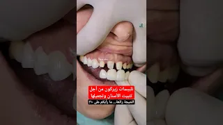 تلبيس اسنان وتركيبات زيركون لتثبيت الاسنان 