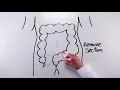 Sigmoidectomy Short version