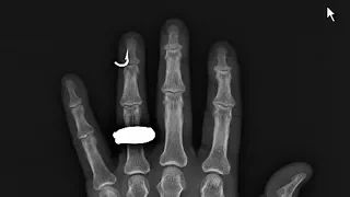 Ep 135 | Disaster at Sea, Dashing Back to Hospital in La Paz, Sailing Pacific Mexico