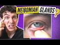 Best Treatment for Meibomian Gland Dysfunction