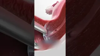 إزالة ورم حميد من جدار الرحم بالمنظار الرحمي 