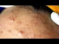 Acne Treatment With Sac Dep Spa