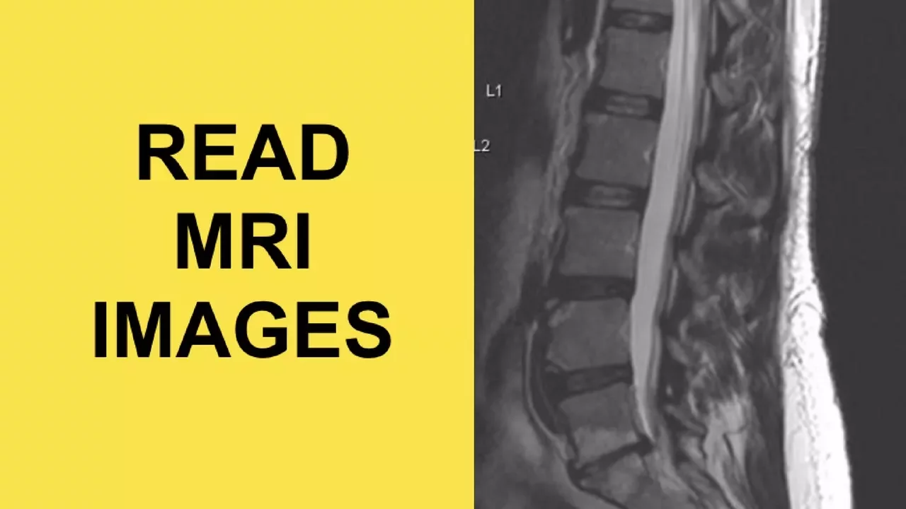 How to Read Your MRI with Onis 2.5 – part I (Advanced Lumbar Spine). 