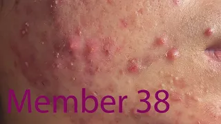 Acne Treatment Huong Da Nang# 038 |  Loyal fans Mai Part 1