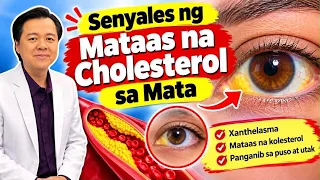 Senyales ng Mataas na Cholesterol sa Mata. Payo ni Doc Willie Ong
