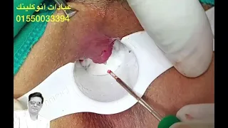 إزالة البواسير بالليزر أ د وائل متولى 