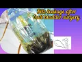 Bile leakage after Gall bladder surgery l DrAshishSachan
