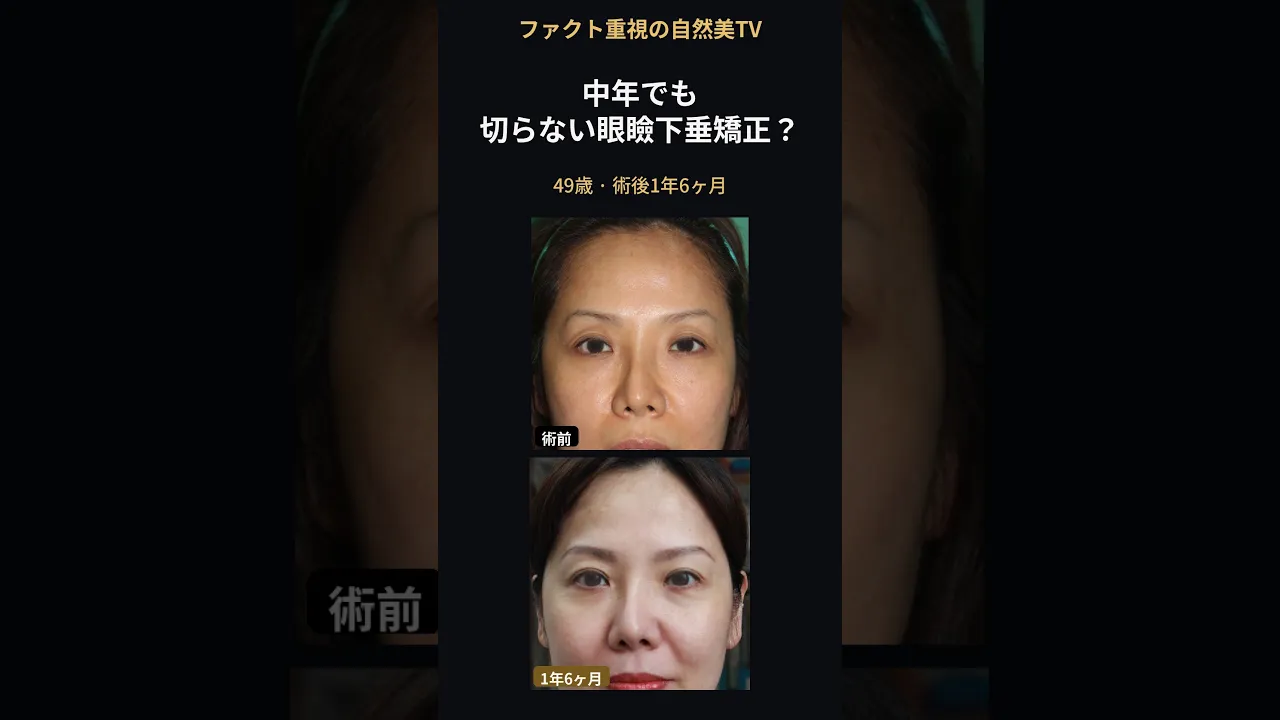 中年でも切らない眼瞼下垂矯正はできる？49歳・術後1年6ヶ月#切らない眼瞼下垂 #眼瞼下垂 #眠そうな目 #韓国美容整形 #shorts