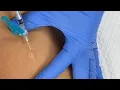 How To Give an Intradermal Injection PPD TB Test Medical Assisting
