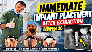 Conventional implant after extraction 