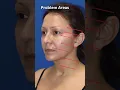 DRAMATIC Facelift Before and After
