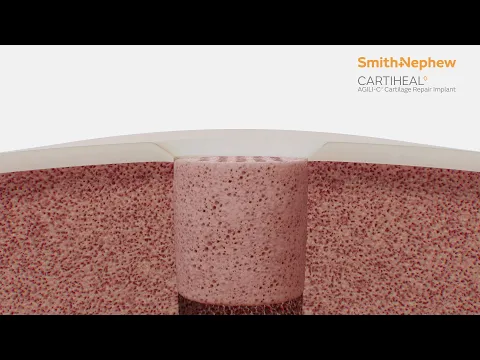 Video: CARTIHEAL Implant – how it works