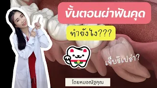  ฟันคุดที่อยู่ลึกในกระดูกต้องผ่าอย่างไรบ้าง 