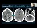 SPINAL CSF LEAKS UPDATES IN DIAGNOSIS AND MANAGEMENT HOW CAN YOUR NEURORADIOLOGIST HELP YOU