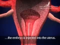 Download Lagu Embryo Transfer