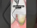 Scaling and root planing 3D Animation