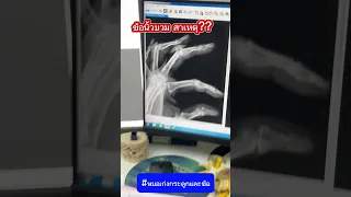  นิ้วบวมและปวดเพียงข้างเดียวเกิดจากสาเหตุอะไร 