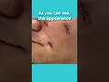 Download Lagu Can these 3 difficult CHICKENPOX SCARS be fixed? | Scar Revision
