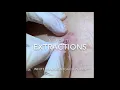 surgery on back Multiple cyst pops Whiteheads