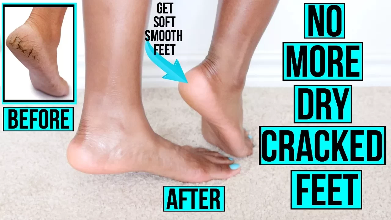 HOW TO MAKE A FOOT SCRUB (REMOVES DEADSKIN )