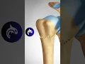 Download Lagu Shoulder Fracture: See Different Proximal Humeral Fractures in 3D #fracture #shoulder