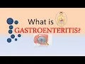 What is Gastroenteritis ICD-10 Codes for Gastroenteritis