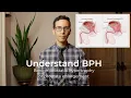 Urologist explains the basics of BPH prostate enlargement benign prostatic hypertrophy