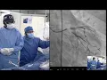 IVUS-Guided Left Main Assessment and PCI of Diffuse LAD ISR
