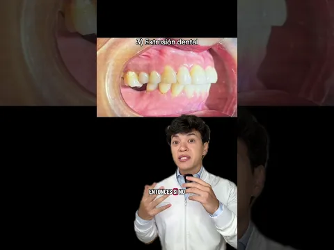 ⚠️ 6 Señales de que necesitas sacarte las muelas del juicio 🦷