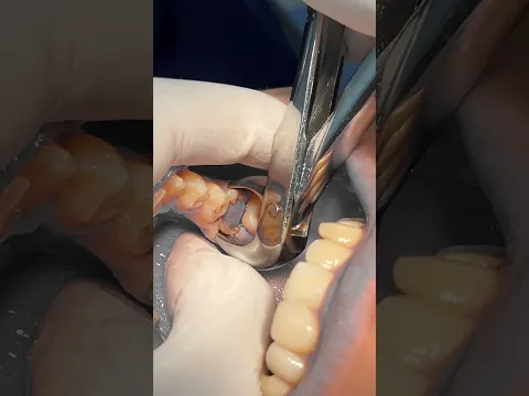 Extraction of badly decayed lower first molar tooth 🦷 #dentist