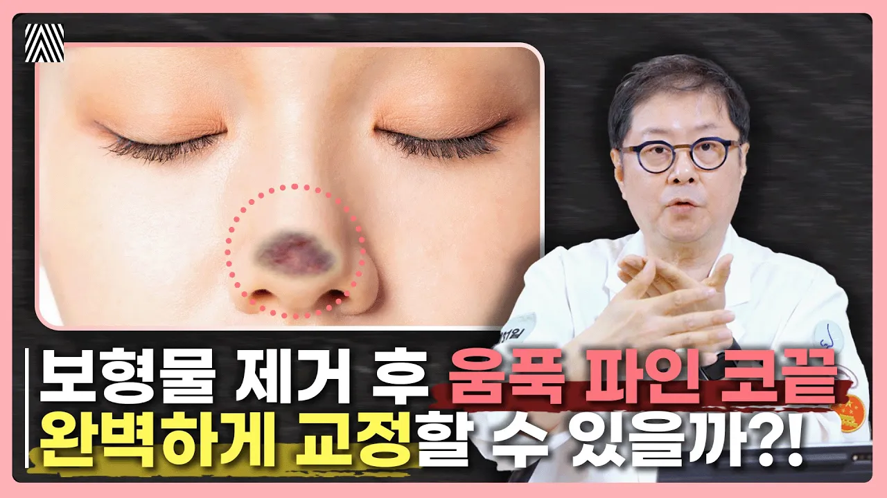 튀어나온 보형물로 생긴 코끝 흉터.. 치료 방법을 순서대로 알려드립니다! 코 보형물 노출 2편_[4월31일 성형외과]