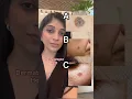 Download Lagu Which One is Melanoma? | Dr. Swati Kannan #shorts