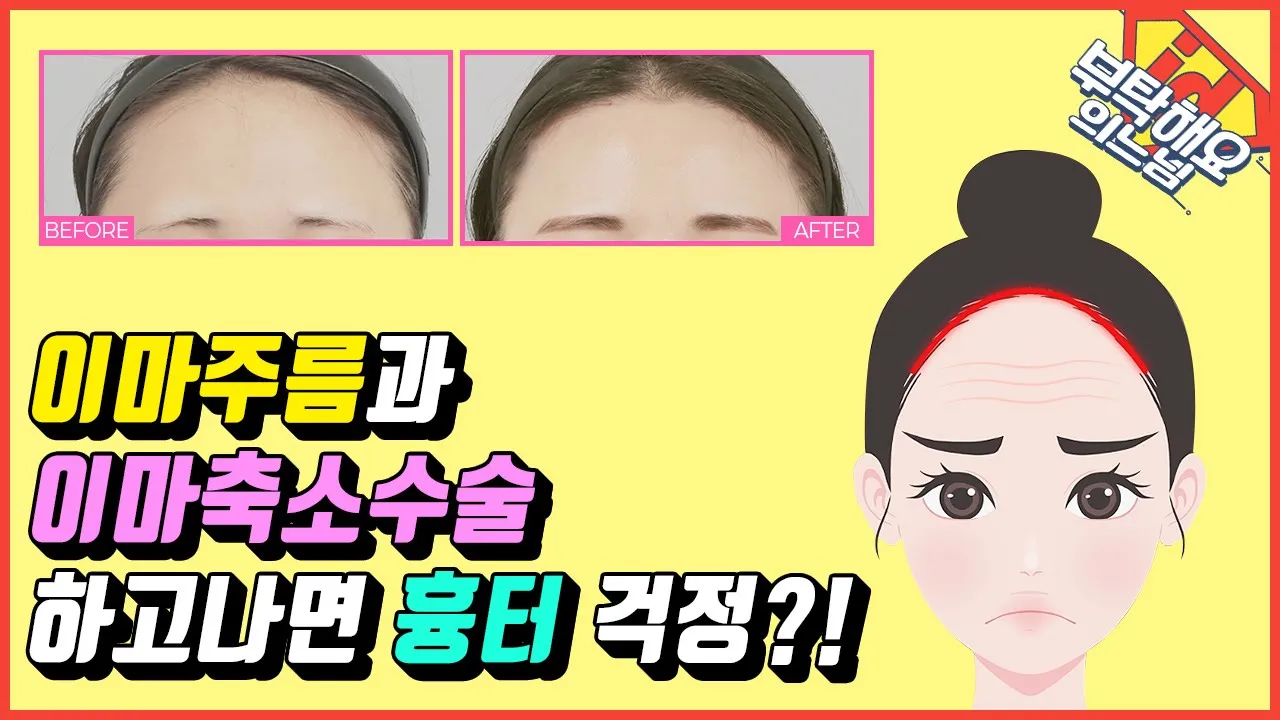 이마리프팅과 이마축소 수술 하고 나면 흉터 걱정?😧 넓은 이마, 이마주름 걱정 없애주는 수술은?│부탁해요의느님👨‍⚕