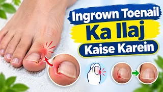 Ingrown Toenail Ka Ilaj Kaise Karein