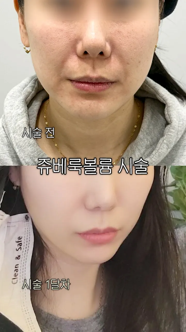 쥬베룩볼륨은 자연스럽게 사라질까?