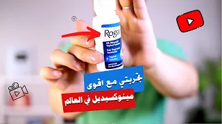 علاج فراغات الشعر نهائيا   تجربتي مع روجين اقوى علاج للصلع الوراثي في العالم دندنها