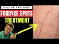 How to treat FORDYCE SPOTS - Doctor O Donovan explains